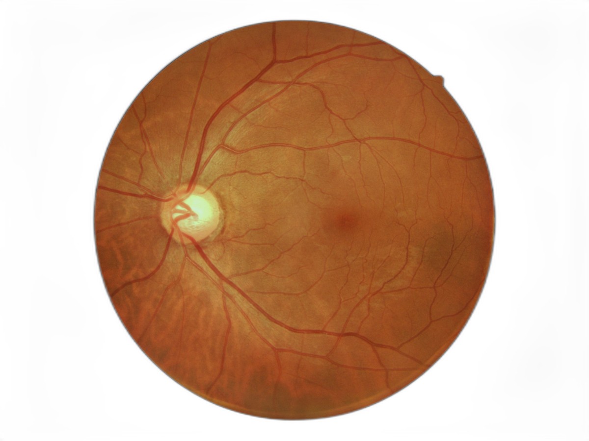 Artelus Glaucoma Sample